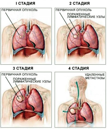 Степени распространенности злокачественного процесса