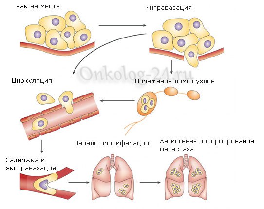 porazheniye limfouzlov metastazami