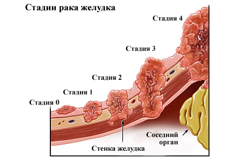 Классификация стадий рака желудка по распространенности онкопроцеса