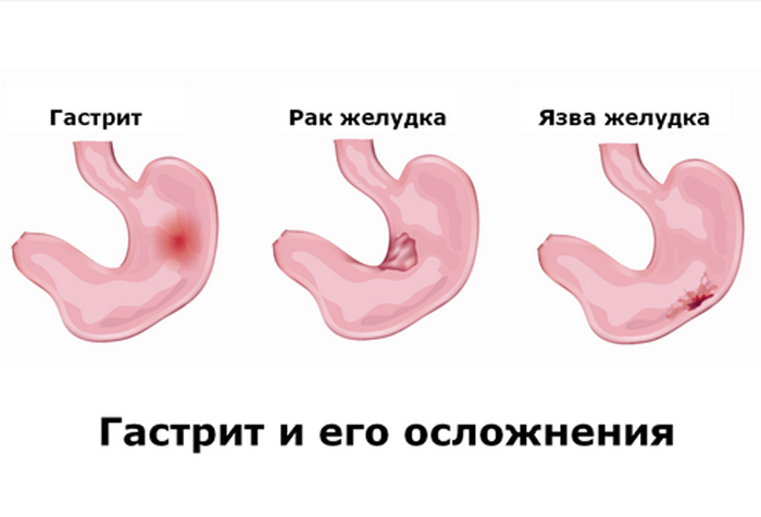 К чему приводят гастрит и язва желудка
