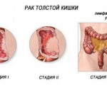Рак желудка и двенадцатиперстной кишки