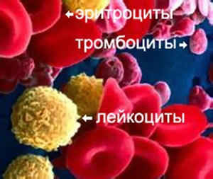 Рак крови 1 стадии