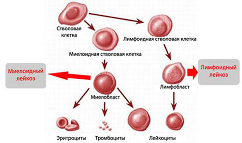 Классификация лейкозов
