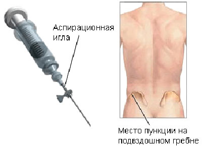 Биопсия