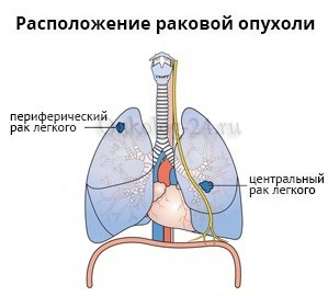 Расположение центрального и периферического рака легких