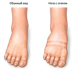 Отеки на ногах при раке печени Отеки на ногах