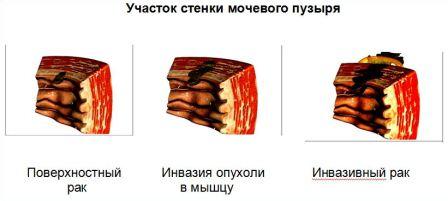 Классификация рака мочевого пузыря