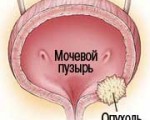 Рак мочевого пузыря: признаки, причины, прогноз и профилактика