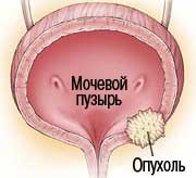 Рак мочевого пузыря