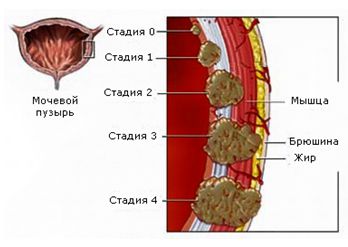 Этапы развития рака