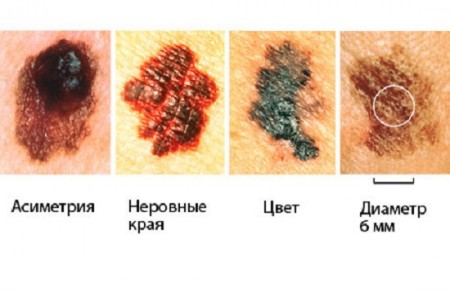Виды рака