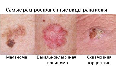 Виды рака