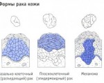 Рак кожи на ноге