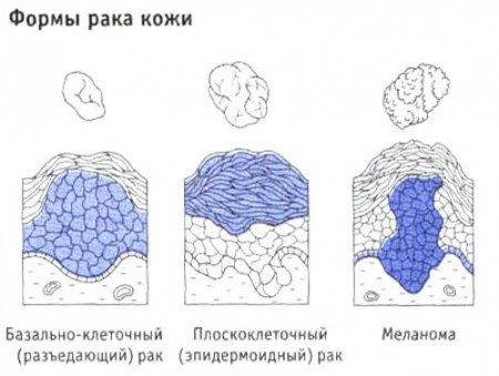 Виды рака кожи