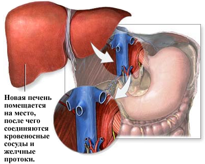 Лечение ХЦР