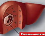 Лечение рака печени