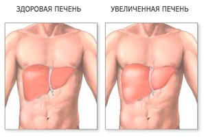 Симптомы недифференцированного рака печени