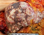 Стадии гепатоцеллюлярного рака печени