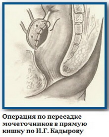 Вторая стадия