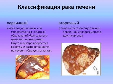Способы классификации и виды рака печени