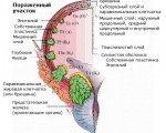 Переходно-клеточный рак мочевого пузыря