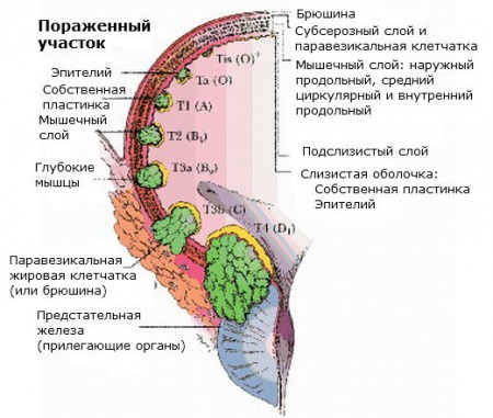 Симптомы и разновидности злокачественных опухолей