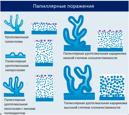 Классификация рака