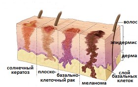 Как распознать тот или иной рак кожи представлено на фото