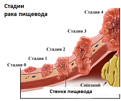 Четвертая стадия