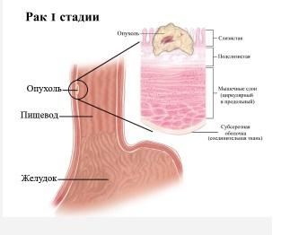 Первая стадия