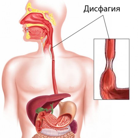 Симптомы заболевания