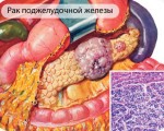 Классификация и виды рака поджелудочной железы