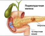 Диагностика рака поджелудочной железы