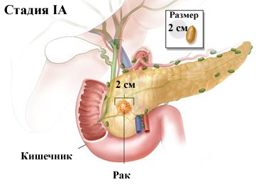 Первая стадия болезни