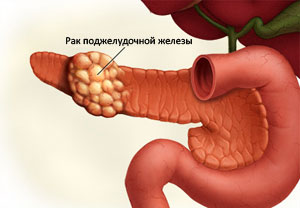 Рак ПЖ у детей и основные симптомы болезни
