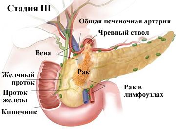 Третья стадия болезни