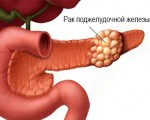 Плоскоклеточный рак поджелудочной железы
