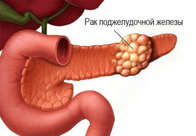 Плоскоклеточный рак