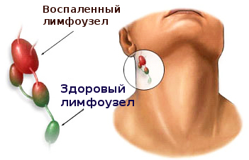 Рак шейных лимфоузлов