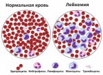 Рак крови