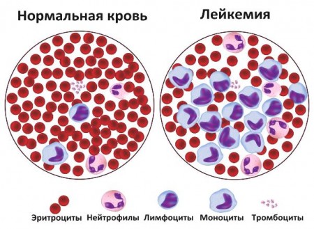 Рак крови