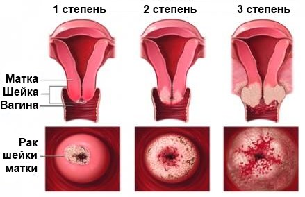 Стадии заболевания