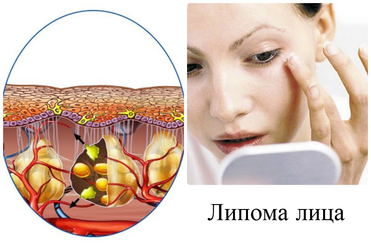 Липома: причины, симптомы, диагностика, лечение и удаление