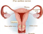 Аденокарцинома шейки матки