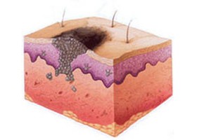Стадии рака кожи