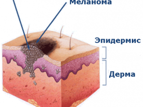 Симптомы и признаки рака кожи