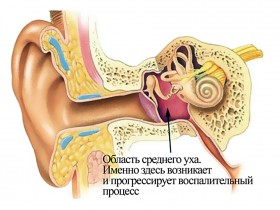 Рак среднего уха