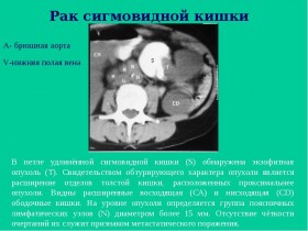 Рак сигмовидной кишки: исследования