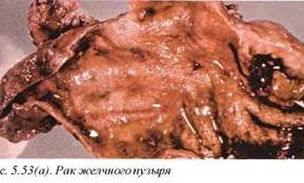 Рак желчного пузыря