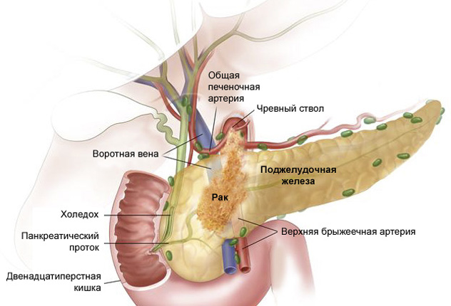 Рак поджелудочной железы